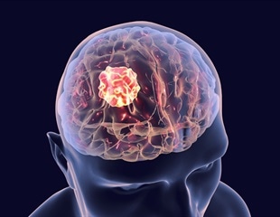 New research pinpoints key culprit behind brain cancer metastasis in children