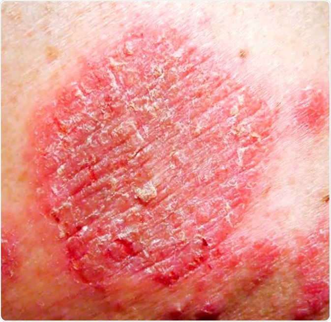 Nummular eczema, also known as nummular dermatitis or discoid eczema