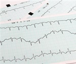 Arrhythmia finding could enhance COPD management