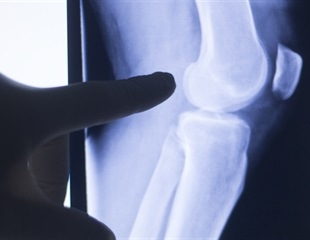 Molecular profiling of diseased joints could transform treatment for rheumatoid arthritis patients