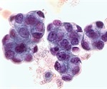 Researchers identify genes associated with biochemical recurrence in prostate adenocarcinoma