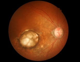 Combination of multiple maps uncovers new genetic risk factor for AMD