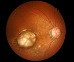 Tiny lumps of calcium phosphate may trigger age-related macular degeneration