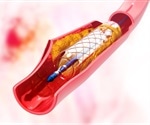 Drug-releasing stent shows promise for improving outcomes in patients with coronary artery disease