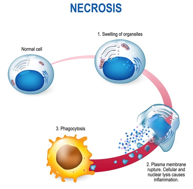 Necrosis - Pathologic Cell Death. Cell injury which results in the premature death of cells in living tissue. Image Credit: Designua / Shutterstock