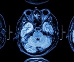 Traumatic brain injury biomarker could help predict patient prognosis