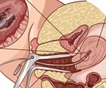 Endometrial Scratching and IVF