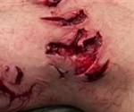 Texas man bitten by shark being treated for flesh-eating bacteria infection