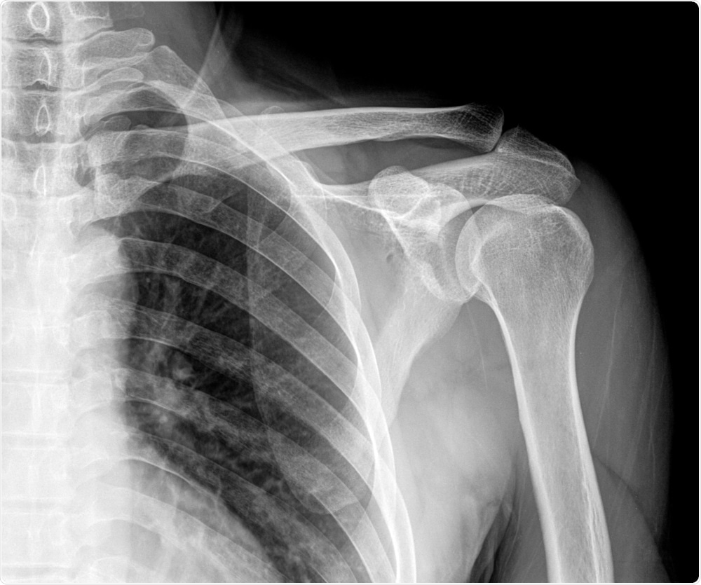 X-ray image of a broken shoulder