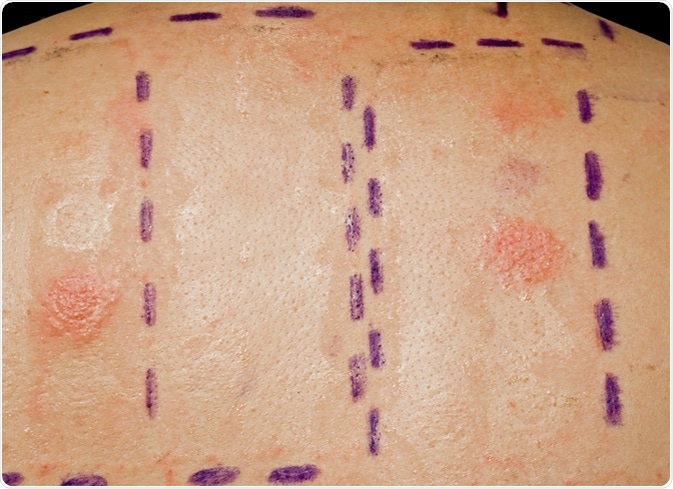 Skin Allergy Patch Test on Back of Patient Showing Redness and Swelling. Image Credit: Andy Lidstone / Shutterstock