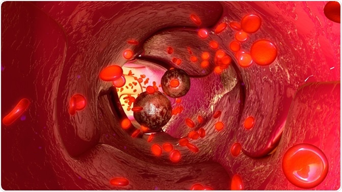 Tumour cells in blood vessels 3d illustration. Image Credit: sciencepics / Shutterstock
