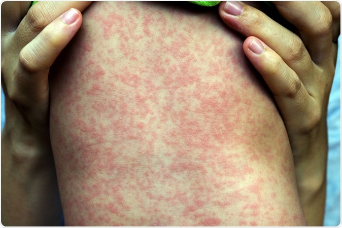 Measles rash: Image Credit: Phichet Chaiyabin / Shutterstock
