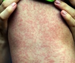 Measles cases on the rise in Europe