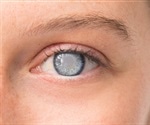 Cataract treatment in the blink of an eye