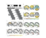 Eye-movement intervention reduces amygdala activity during recall of traumatic memory