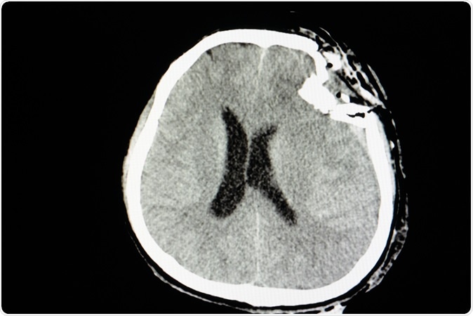 CT skull film of a patient with traumatic brain injury showing compression depression fractures of left temporoparietal bone. Image Credit: Sopone / Shutterstock