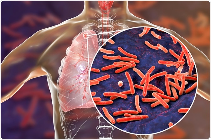Secondary tuberculosis in lungs and close-up view of Mycobacterium tuberculosis bacteria, 3D illustration. Image Credit: Kateryna Kon / Shutterstock