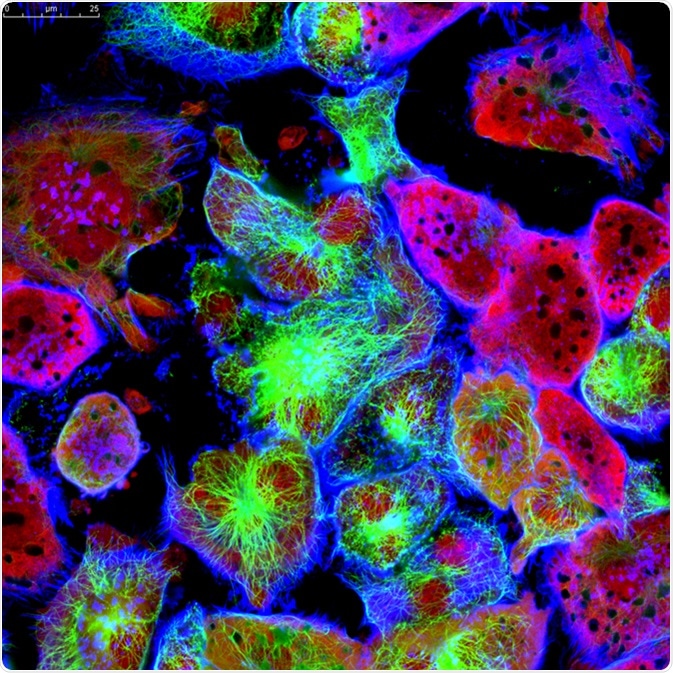 Tumor cells under microscope labeled with fluorescent molecules. Image Credit: Vshivkova / Shutterstock