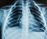 Acute Respiratory Distress Syndrome (ARDS) and Sepsis