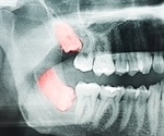 Why Don't All Wisdom Teeth Descend in Adults?