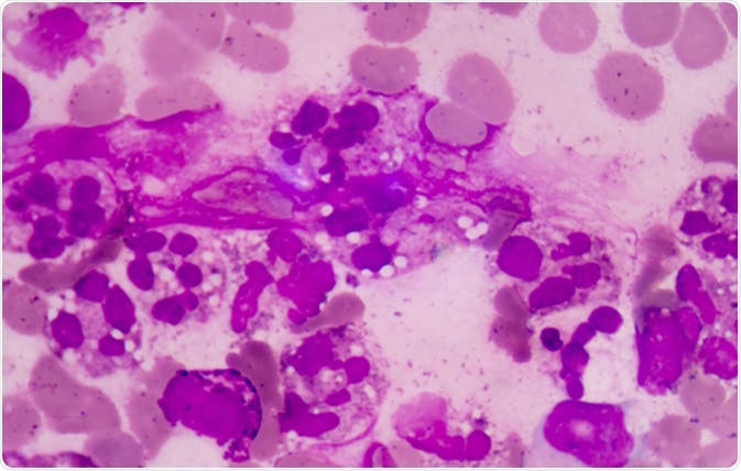 Abnormal neutrophil in pleural fluid smear. Sepsis or septicaemia is a life-threatening illness. Presence of numerous bacteria in the blood, causes the body to respond in organ dysfunction. Image Credit: Toeytoey / Shutterstock