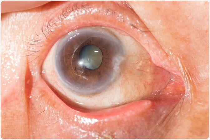 Close up of the senile cataract during eye examination, senile cataract, mature cataract, neuclear sclerosis cataract. Image Credit: ARZTSAMUI / Shutterstock