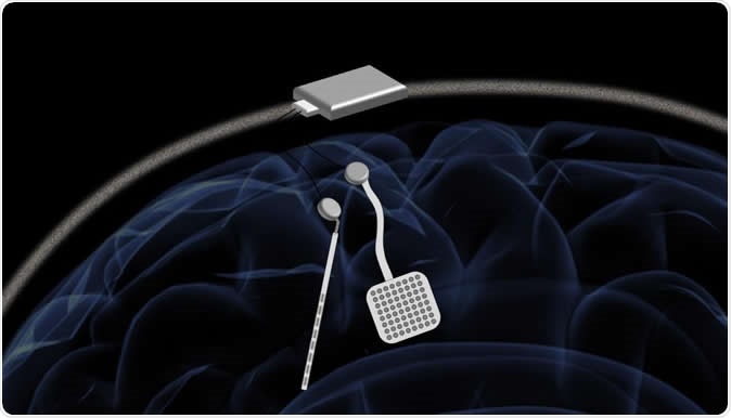 In a proposed device, two of the new chips would be embedded in a chassis located outside the head. Each chip could monitor electrical activity from 64 electrodes located into the brain while simultaneously delivering electrical stimulation to prevent unwanted seizures or tremors. Image Credit: Rikky Muller, UC Berkeley