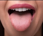 Microbes on the tongue could be used to diagnose pancreatic cancer