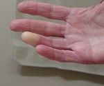 Raynaud’s Syndrome Causes