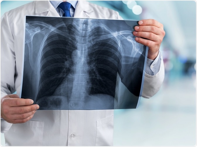 Doctor holding up X-ray of lungs