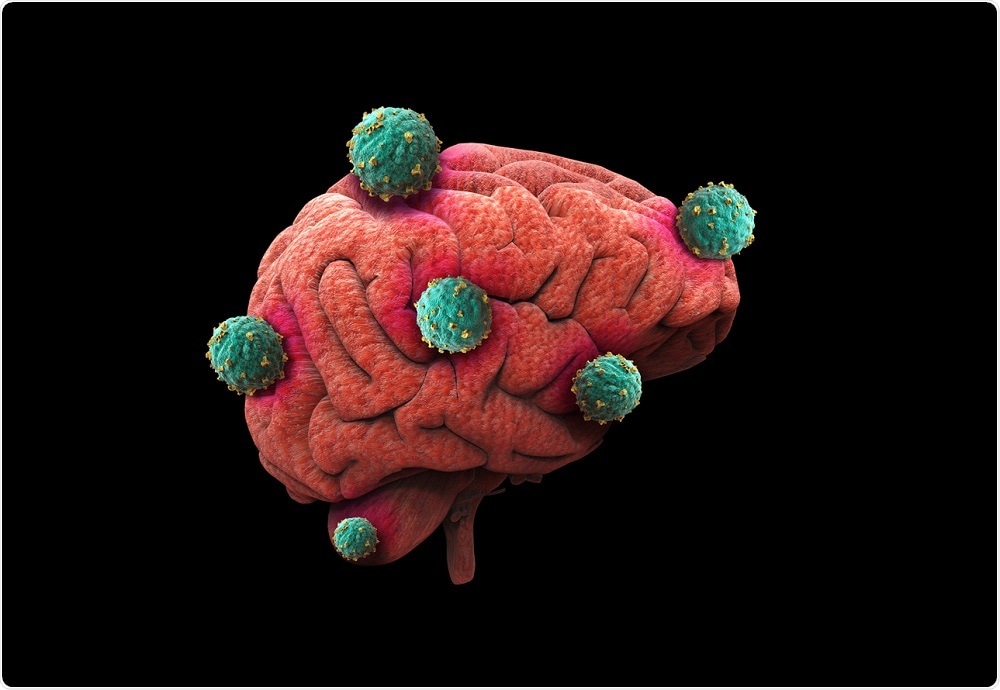 Glioblastoma illustration - brain with tumors - by Giovanni Cancemi