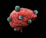 Molecular signatures reveal why women are more likely to die from glioblastoma