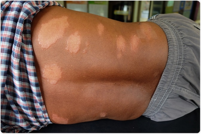 Skin on the back of a man who has been infected with leprosy - By MR.PRAWET THADTHIAM