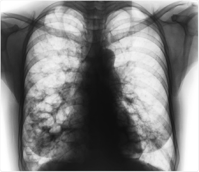 X-ray of lungs that have been damaged by bronchiectasis - photo by Puwadol Jaturawutthichai
