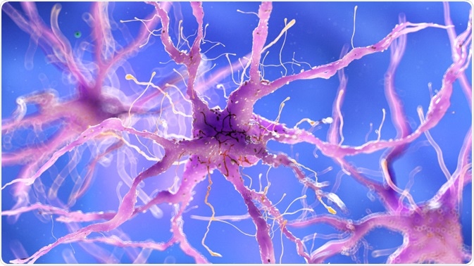 Neurons with amyloid plaques - an illustration of the amyloid cascade hypothesis By Sebastian Kaulitzki