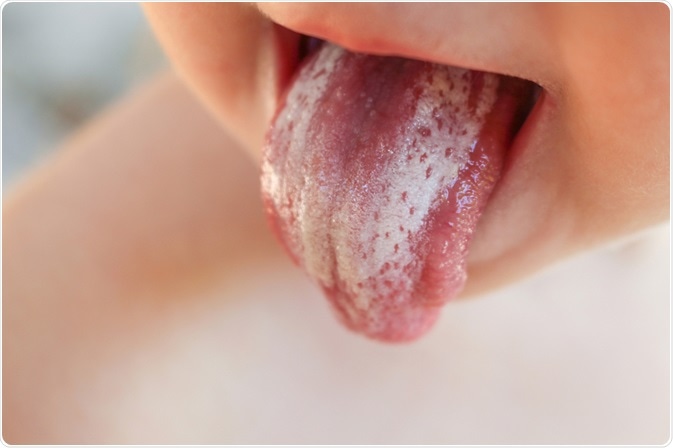 Picture of young boy with oral thrush on the tongue - By Victoria 1