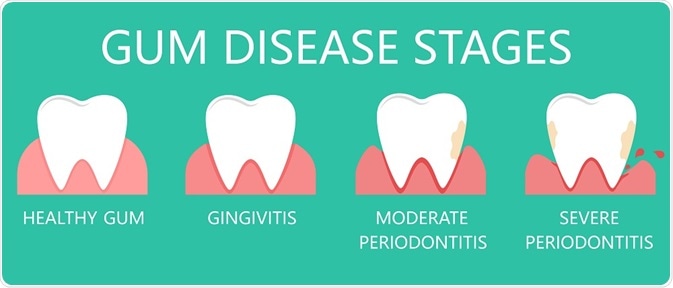 Diagram showing the stages of gum disease - illustration by diluck