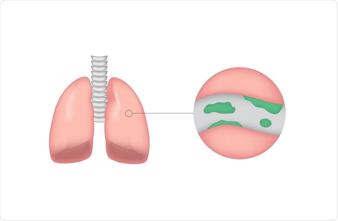 Illustration of the mucus build up that occurs in bronchiectasis - by joshya