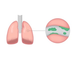 Color of the phlegm can indicate degree of lung inflammation in patients with bronchiectasis