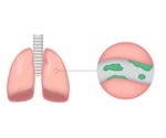 Color of the phlegm can indicate degree of lung inflammation in patients with bronchiectasis