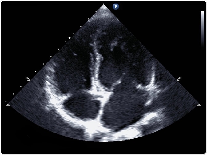Standard transthoracic two-dimensional echocardiography in a patient with hypertension - picture by kalewa