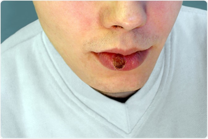 Primary syphilis - indurated chancre on the lip. Image Credit: Nau Nau / Shutterstock