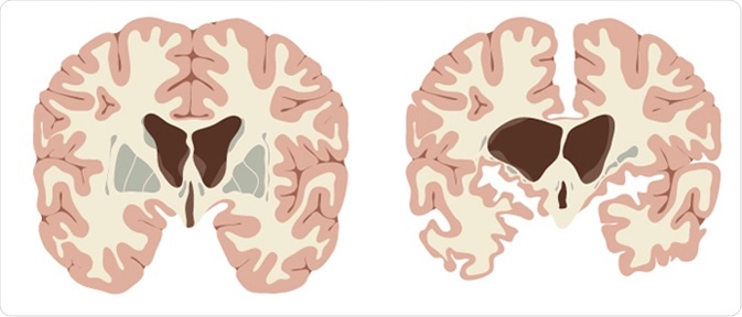Normal brain and brain with Huntington
