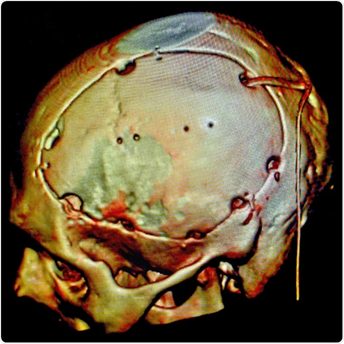 Neurosurgery, Craniotomy, CT - Image Credit: Semnic / Shutterstock