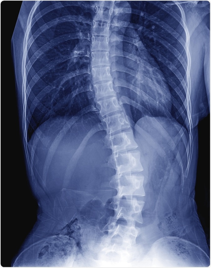 X-ray image of child patient spine show Scoliosis. Image Credit: ChooChin / Shutterstock