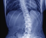 Treatments for Pediatric Spinal Deformities