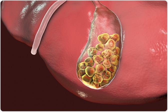 Gallstones, 3D illustration showing bottom view of liver and gallbladder with stones. Image Credit: Kateryna Kon / Shutterstock