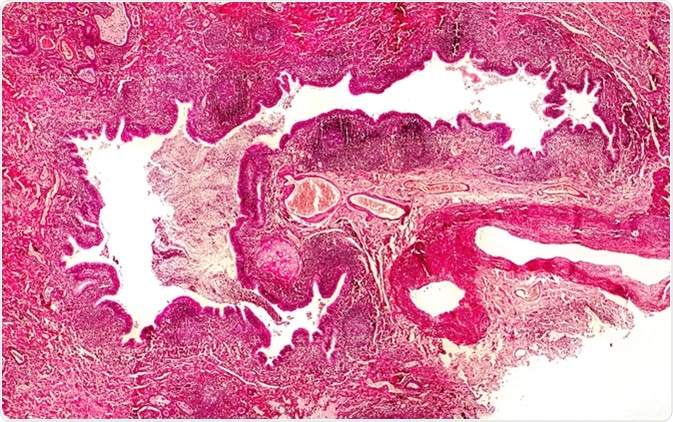 Bronchiectasis, cross-section through bronchus. Light photomicrograph showing dilatated and distorted bronchus containing pus - Image Credit: Kateryna Kon / Shutterstock