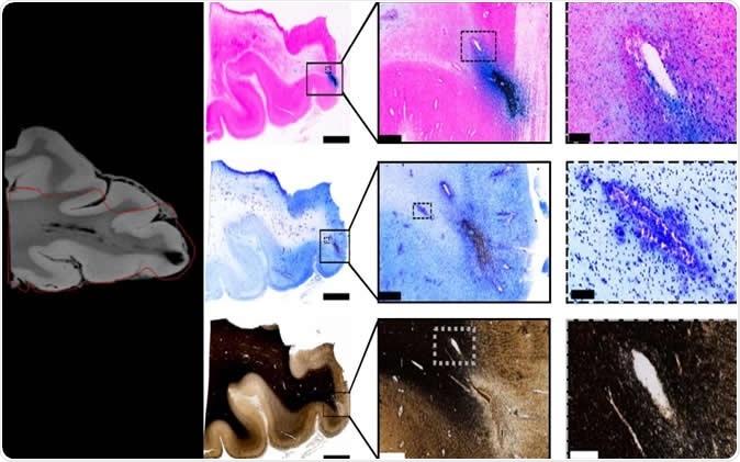 Tissue imaging confirms blood vessel damage in traumatic brain injury patients. Image Credit: Mitra lab/CSHL, 2019