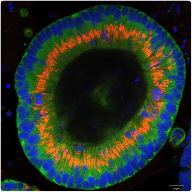 Colon cancer cells grow into three-dimensional organoids in the culture dish. Dr. Joseph Regan / Charité - Universitätsmedizin Berlin